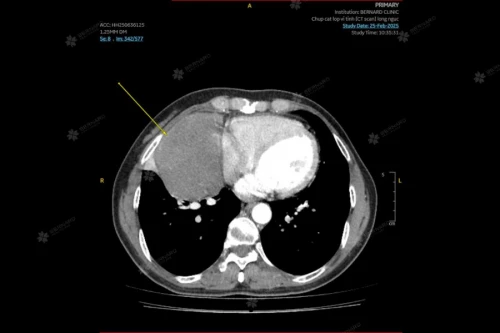 U trung thất có thể gây ra những biến chứng nào?
